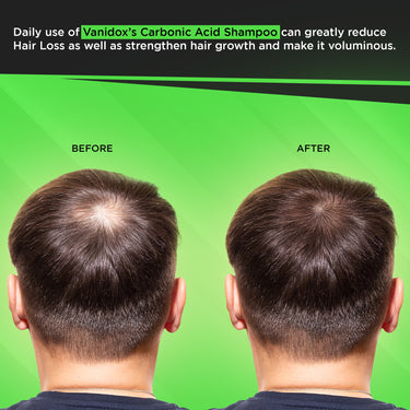 Carbonic Acid Shampoo | Revitalizes Hair Growth | Scalp Soothing Formula | Washes away Dandruff